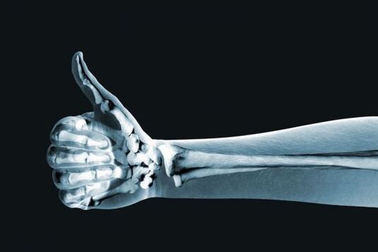 X-ray to diagnose pain in the finger joints