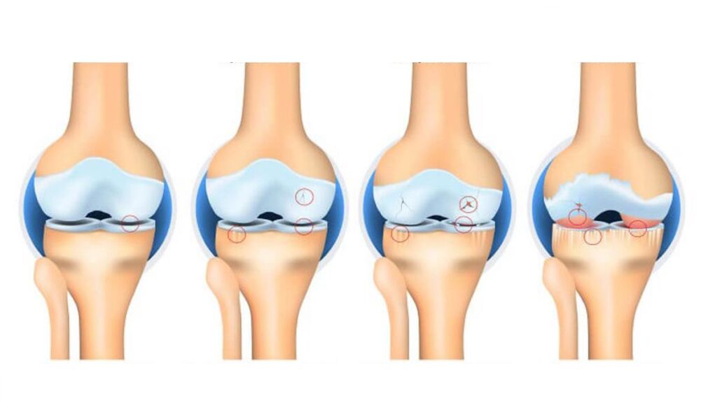 stage of osteoarthritis of the knee joint