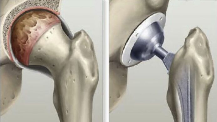 Hip replacement performed in the final stage of coxarthrosis