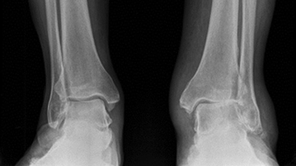x-ray of the ankle joint