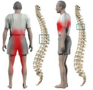 Lumps in the spine