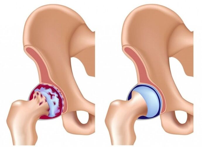 Damage to the hip joint due to arthrosis
