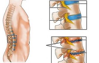 Causes of osteochondrose lumbar