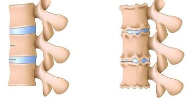How to recognize the presence of osteochondrose lumbar