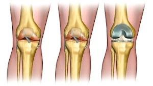 endoprosthetics for osteoarthritis of the knee joint